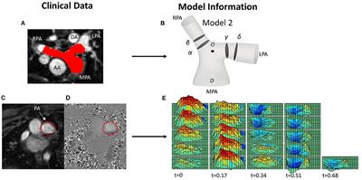 Characterization of Flow Dynamics in the Pulmonary Bifurcation of Patients With Repaired Tetralogy of Fallot: A Computational Approach